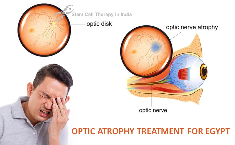 Optic Nerve Atrophy Stem Cell Treatment for Egypt Patients